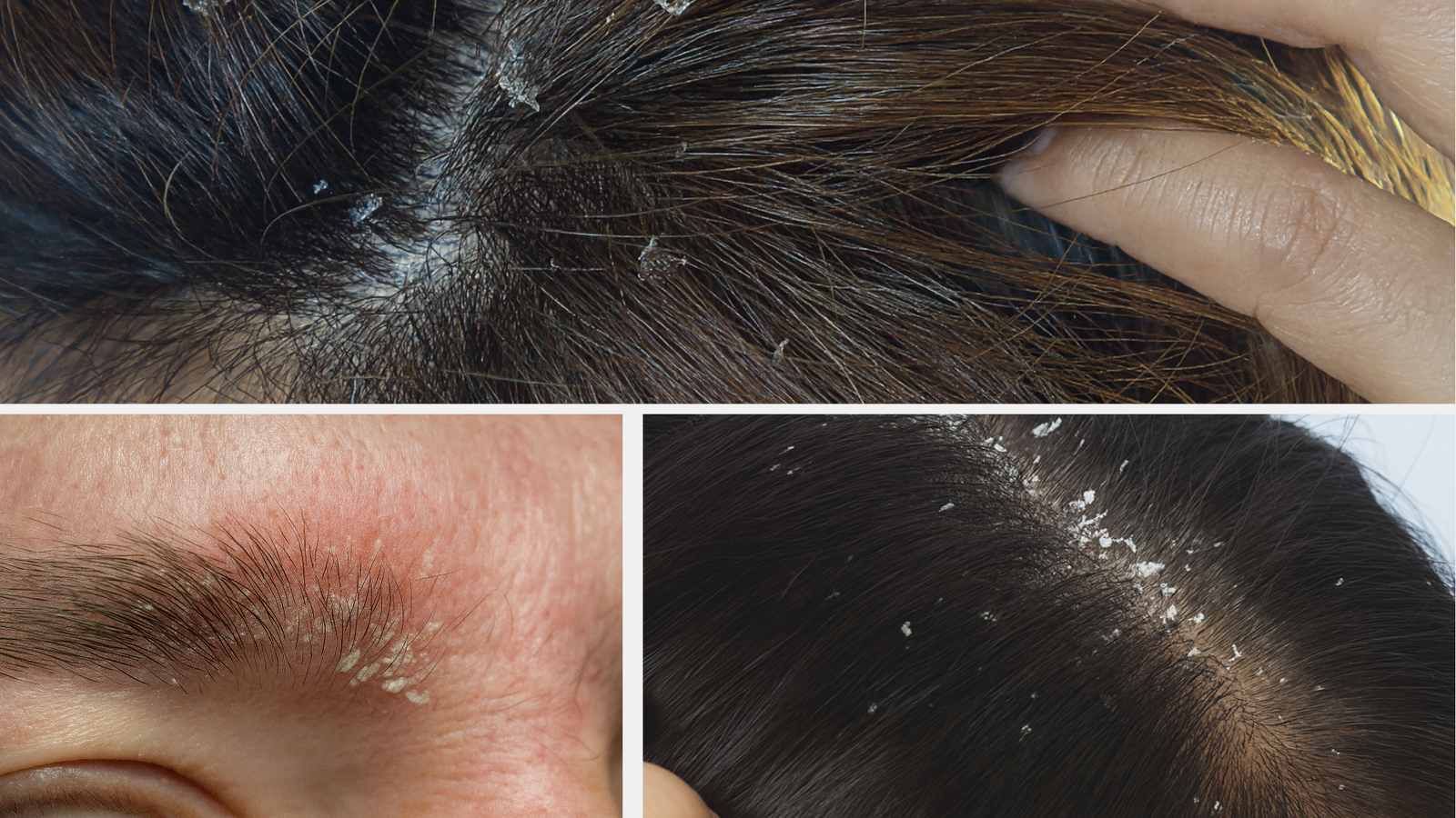 Skin Dander Dandruff And Seborrheic Dermatitis: Understanding, Treating, And Caring ...